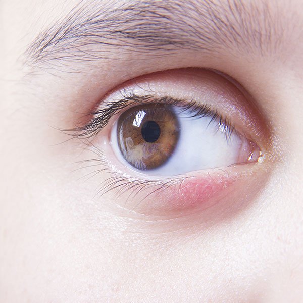 Eye with Blepharitis