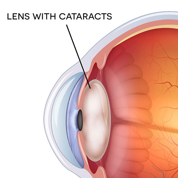 Lens with Cataracts