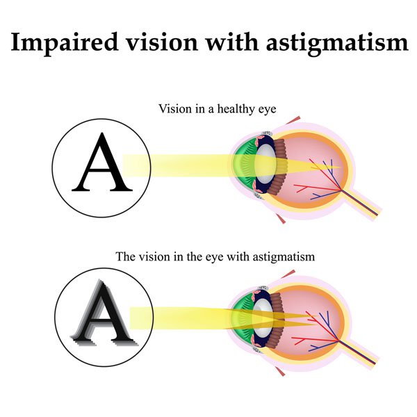Comparision between Astigmatism & Healthy Eye